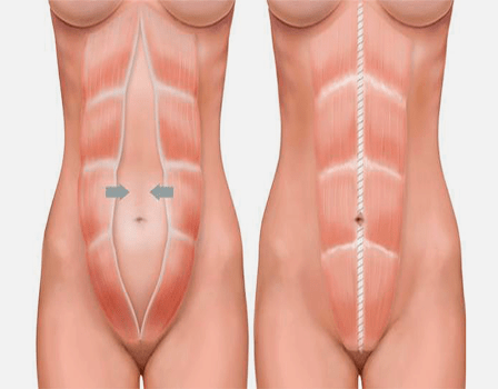 Abdominoplastia